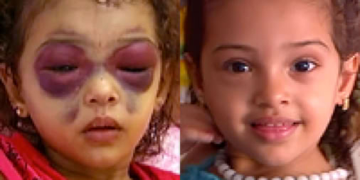 Young girl with eye problems